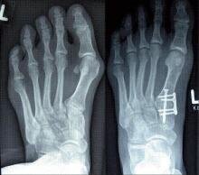 Röntgenbild des Fußes